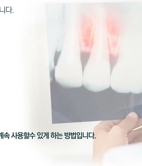 신경치료 전 방사선 사진으로 치아 상태를 확인하는 모습